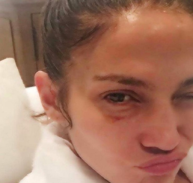 Jennifer Lopez sports nasty black eye but says ‘nobody hit me’